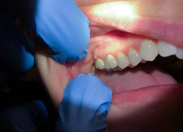 Best Emergency Care for Gum Disease in Canton Valley, CT